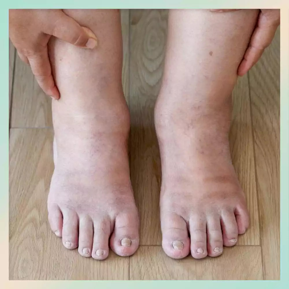 swollen feet & legs